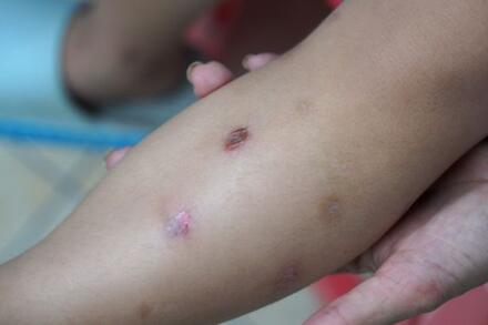 Nhiều trẻ mắc bệnh chốc, nguy cơ lây lan cao