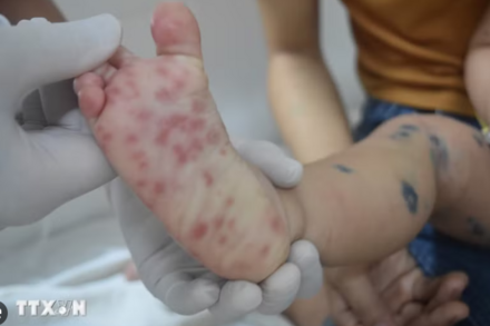 Kịp thời cứu chữa hai bé trai nguy kịch do chủng virus EV71 gây ra