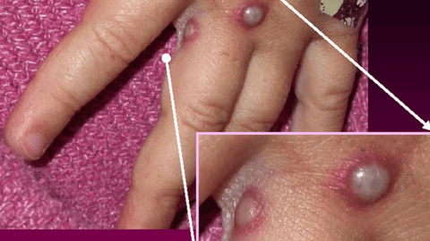 Bộ Y tế nêu 6 biện pháp phòng chống bệnh đậu mùa khỉ