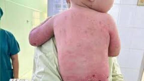 Hỗ trợ đưa cháu bé bị bỏng nặng đi cấp cứu, bảo toàn tính mạng