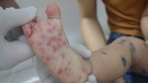 Kịp thời cứu chữa hai bé trai nguy kịch do chủng virus EV71 gây ra