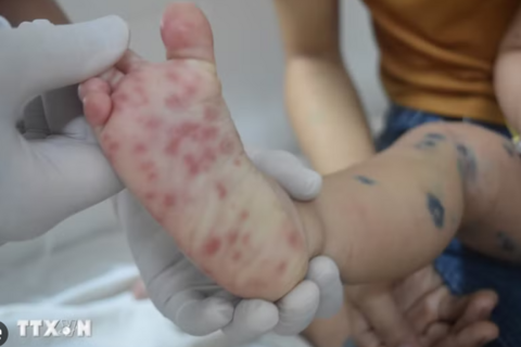 Kịp thời cứu chữa hai bé trai nguy kịch do chủng virus EV71 gây ra