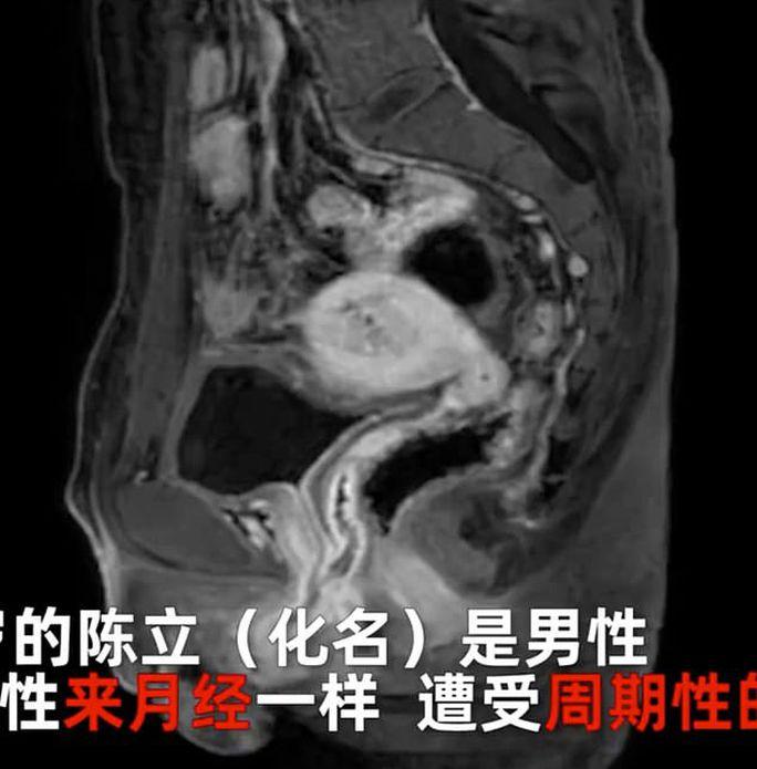 Trung Quốc: Người đàn ông có buồng trứng, tử cung và kinh nguyệt - Ảnh 2.