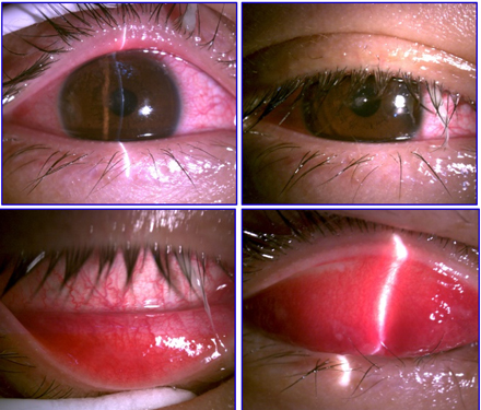 Một trường hợp bị viêm kết mạc do sử dụng kính áp tròng thiếu kiểm soát Một trường hợp bị viêm kết mạc do sử dụng kính áp tròng thiếu kiểm soát