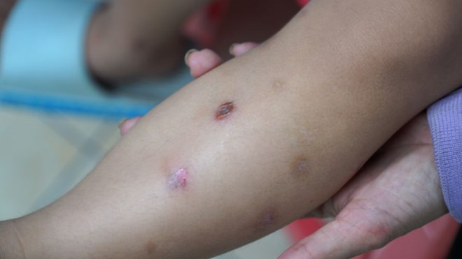 Nhiều trẻ mắc bệnh chốc, nguy cơ lây lan cao