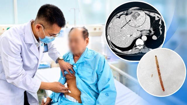 Bác sĩ lấy xương cá dài 3 cm khỏi ổ áp xe gan của cụ ông 82 tuổi
